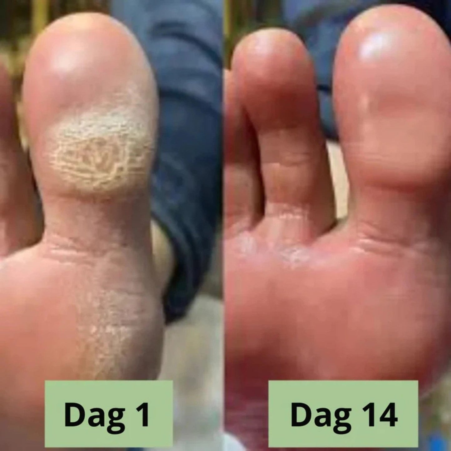 NORDESTO™ Anti-Pilz Seife — Tägliche Pflege gegen Nagelpilz