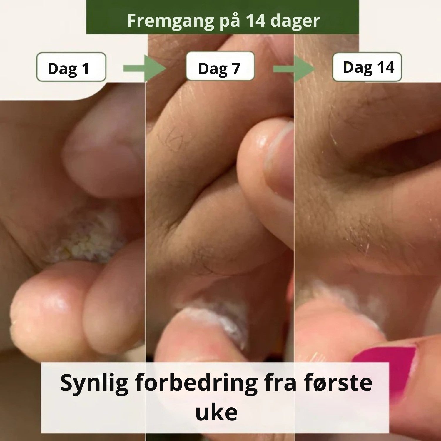 NORDESTO™ Anti-Pilz Seife — Tägliche Pflege gegen Nagelpilz