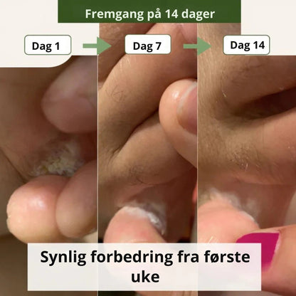NORDESTO™ Anti-Pilz Seife — Tägliche Pflege gegen Nagelpilz