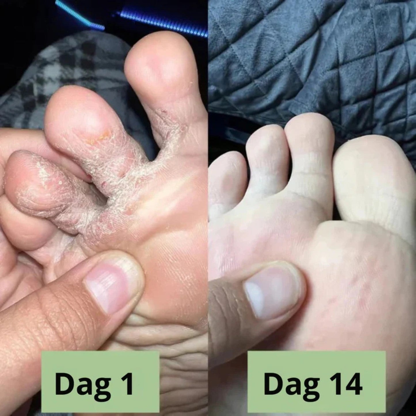 NORDESTO™ Anti-Pilz Seife — Tägliche Pflege gegen Nagelpilz