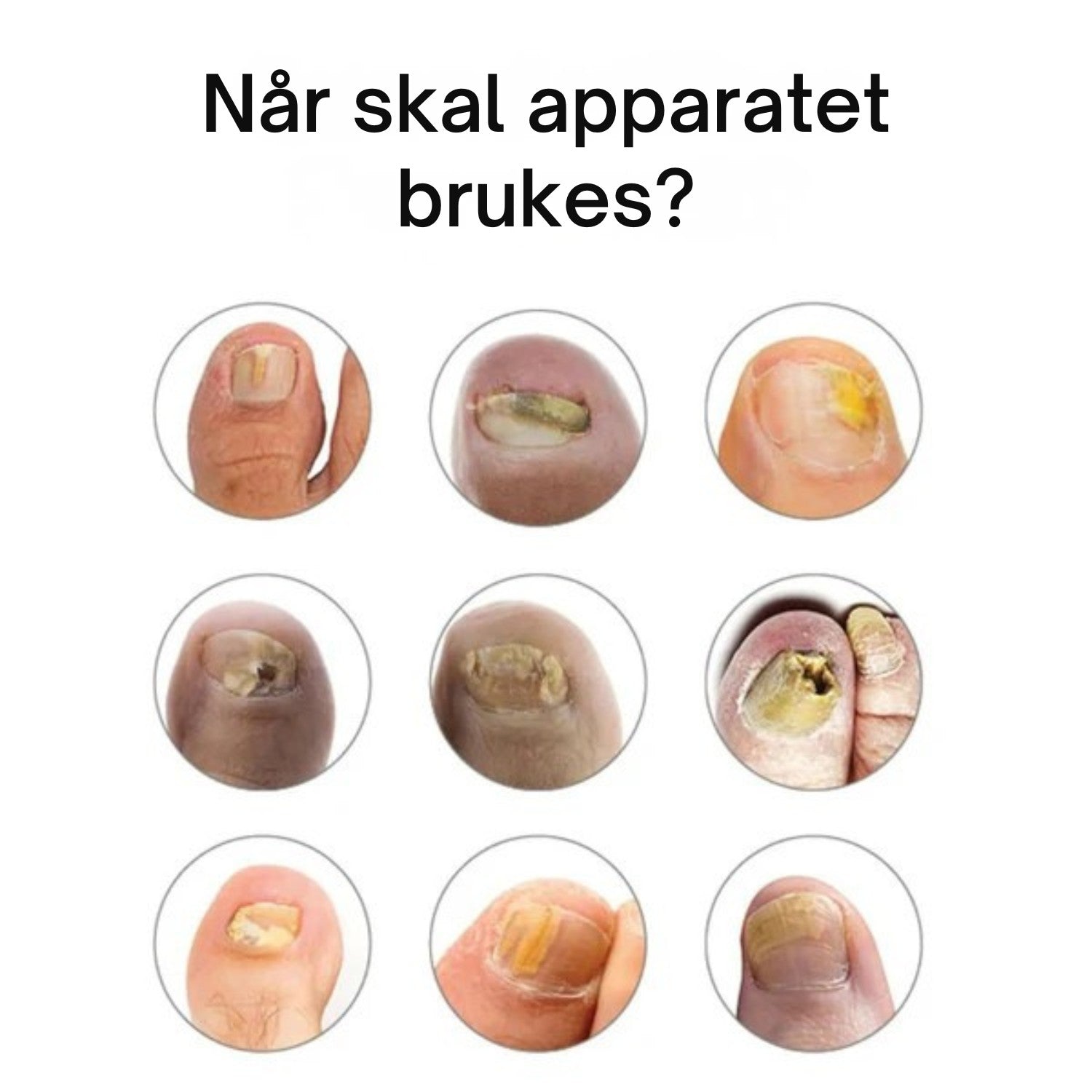 NORDESTO™ Klarnagel — Anti-Pilz Behandlungsgerät für Nägel