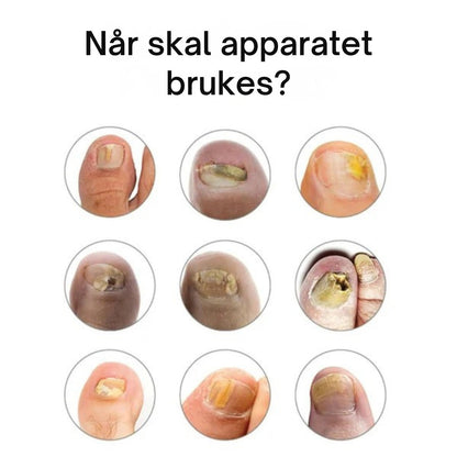 NORDESTO™ Klarnagel — Anti-Pilz Behandlungsgerät für Nägel